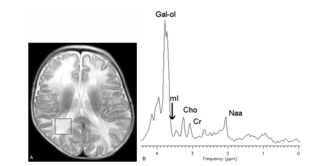 Proton MR Spectroscopy-Imaging Galactosemia Patient Before and After Dietary Treatment Management